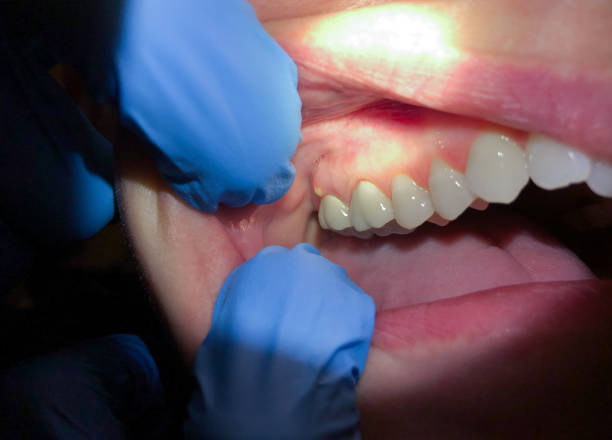 Best Emergency Denture Repair in Laurel Hollow, NY